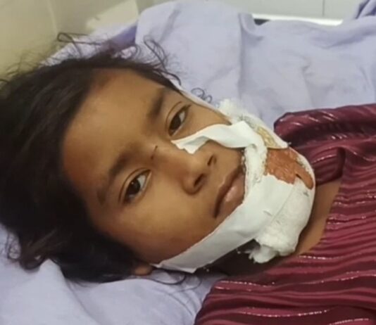 बहराइच में कुत्ते ने बच्ची पर किया हमला:चेहरे पर घाव के गहरे निशान, जिला अस्पताल में इलाज जारी