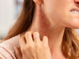 गर्मी में क्या करें कि त्वचा घमौरियों से रहे सुरक्षित? नोट कर लीजिए टिप्स