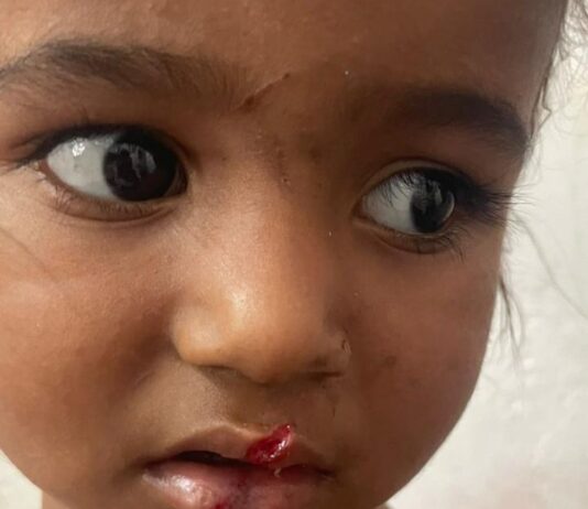 सौतेली मां ने ढाई साल की बच्ची को पीटा:बस्ती के कुर्दा गांव में शौच करने पर घायल किया, FIR दर्ज