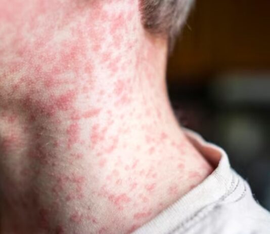 बांग्लादेश में खसरे के कारण 100 से ज्यादा बच्चों की मौत, जानिए लक्षण और बचाव